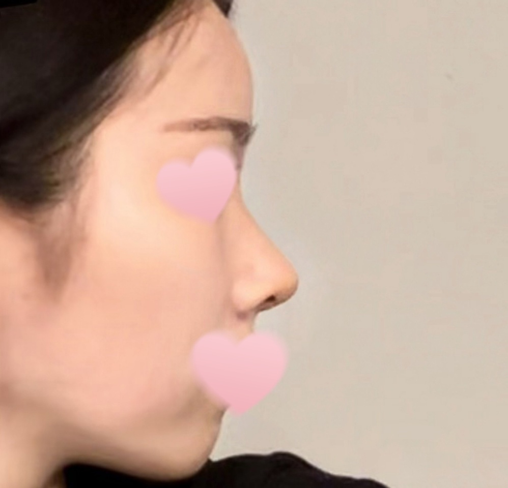 무보형물 매부리코성형 3주차 성공후기!!