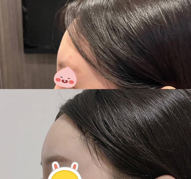 엄청 손품하고 바이브로 선택! 지방이식 넘만족><