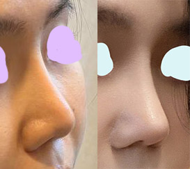 코재수술후기! 세련되어보여용