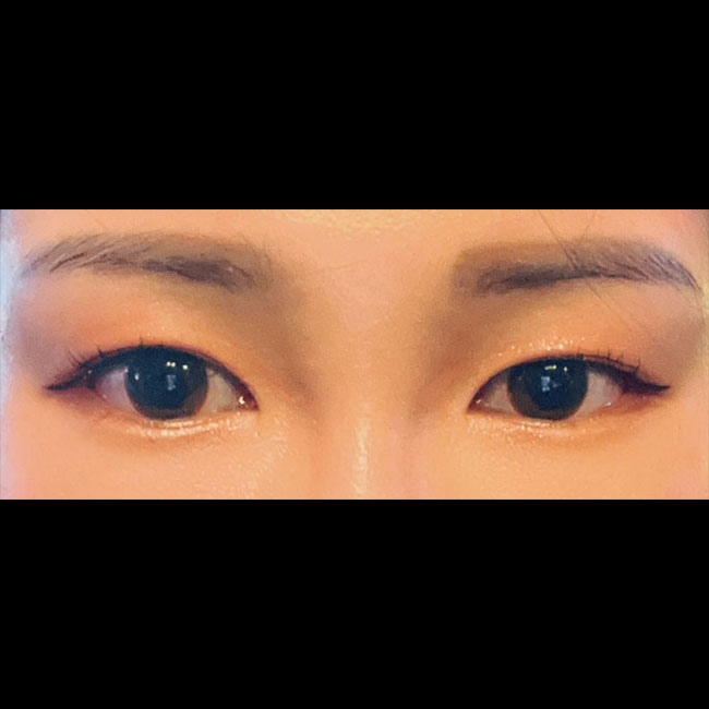 눈성형(뒤트임, 밑트임) 대성공적