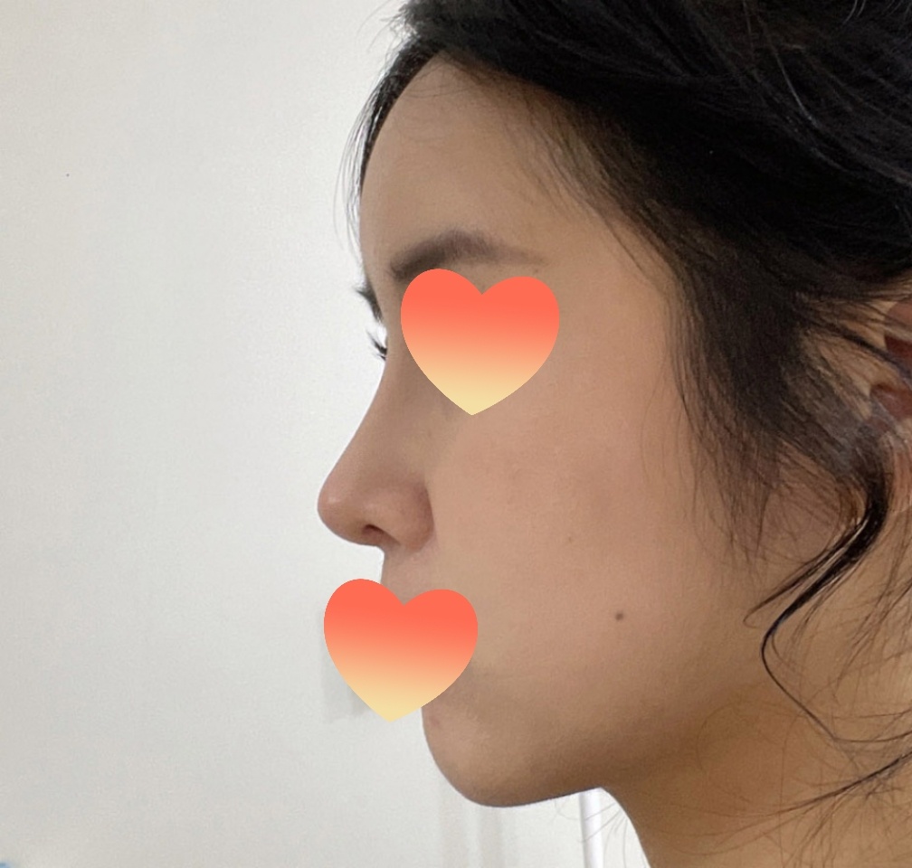 코수술&풀페이스지방이식 적극추천:)