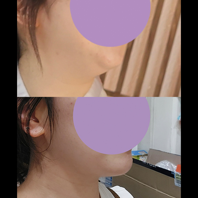 투턱고민이면 얼지흡 강추함!!!