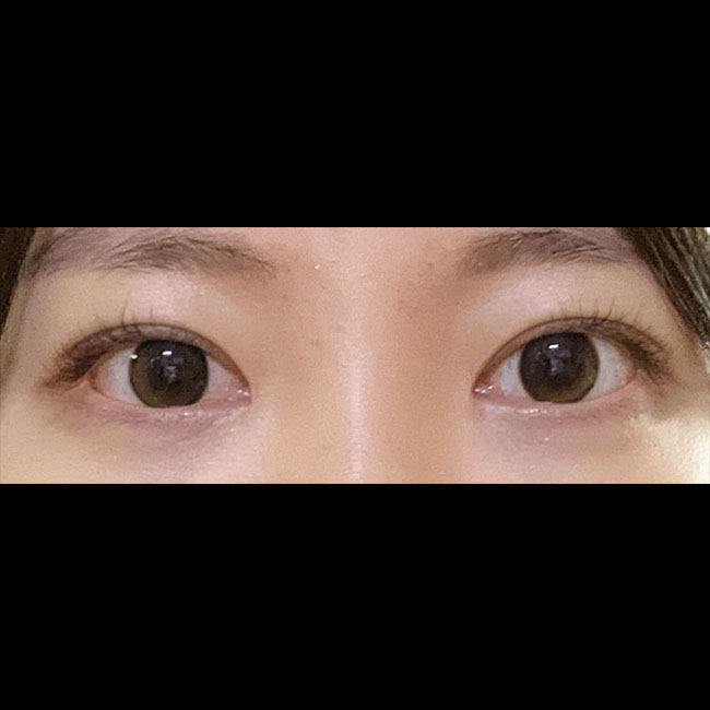 부분절개랑 앞트임성형했다요