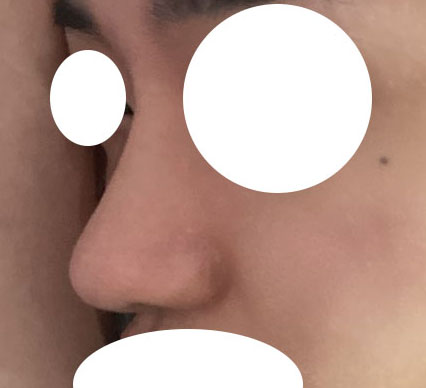 남자코수술 7개월차입니다:)