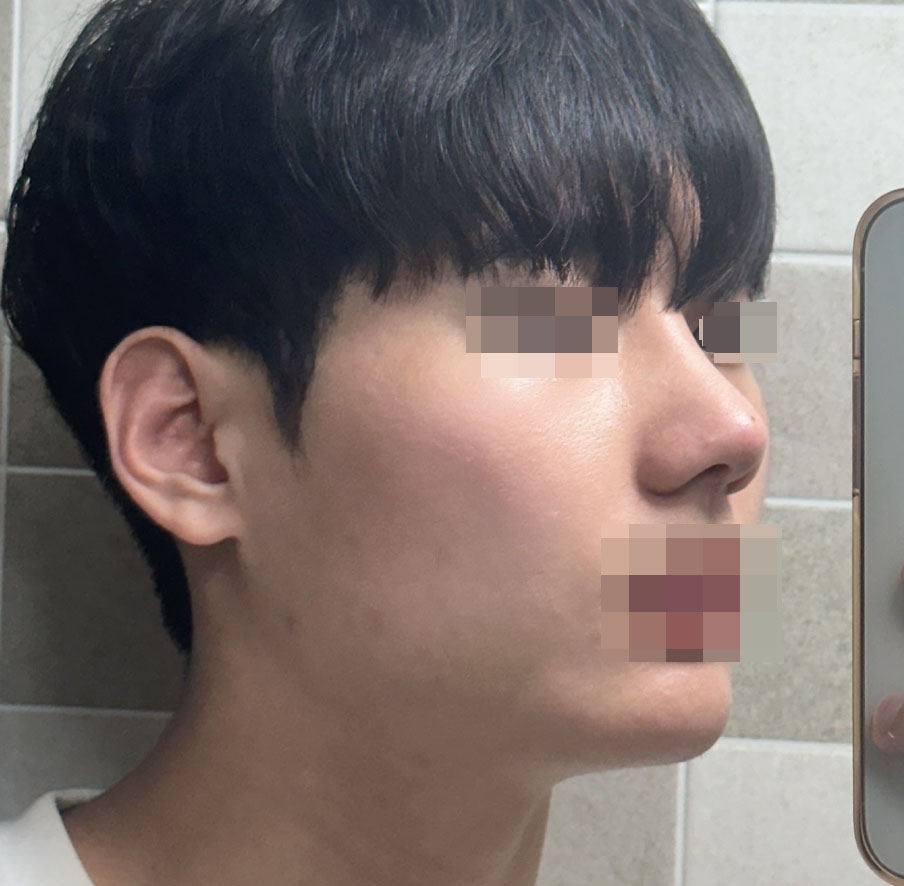 상담 제일 맘에 들어서 선택했는데 코성형 후회없어요