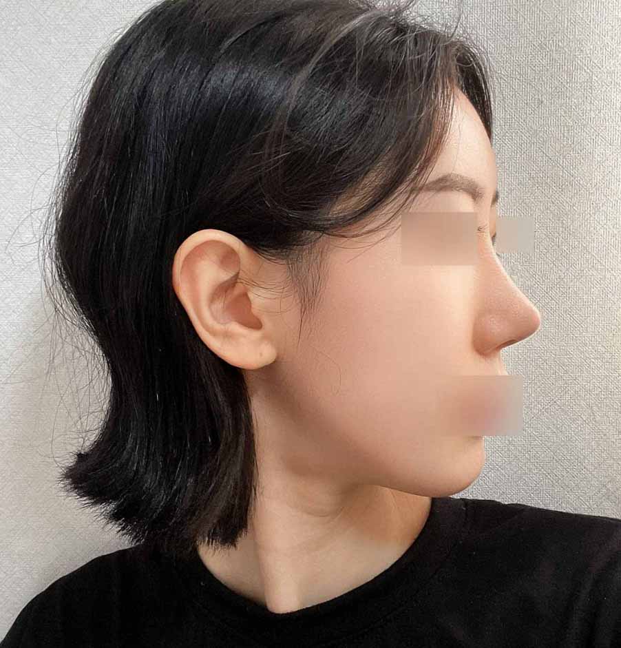 풀페이스지방이식+코 3개월