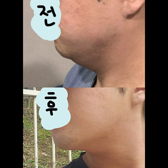 1._수술전후측면.jpg