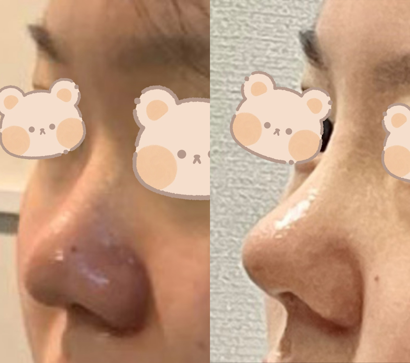 딱 제가 원하던 코에요!!!