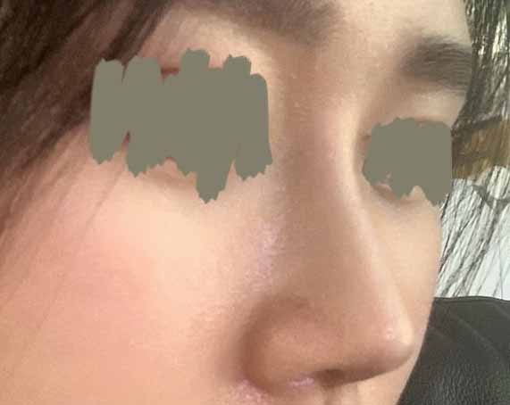 코재수술 너무 잘됐어요ㅎㅎ