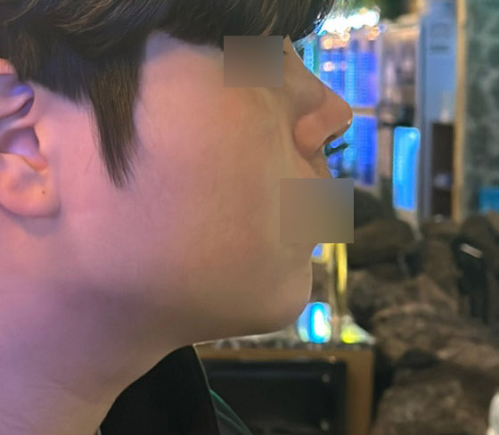 남자 얼굴지흡+코후기!원장님감사합니다.