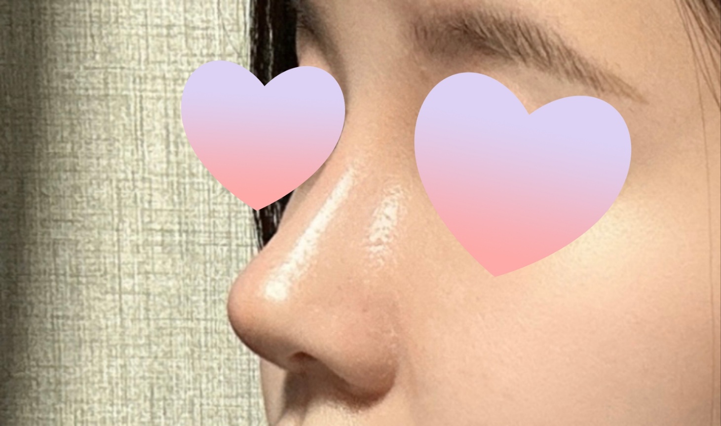 복코+매부리코 벗어난지 3주차!!