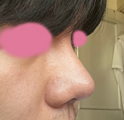 남자눈+코수술 세달차에요