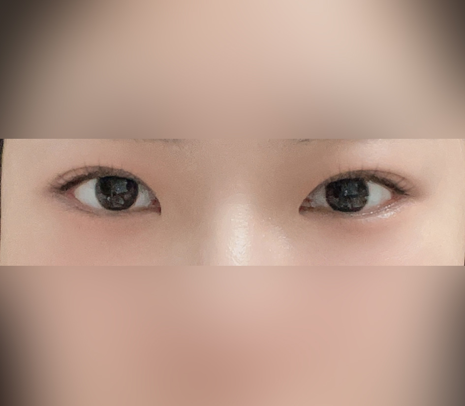 바이브에서 부분절개눈매교정했습니당