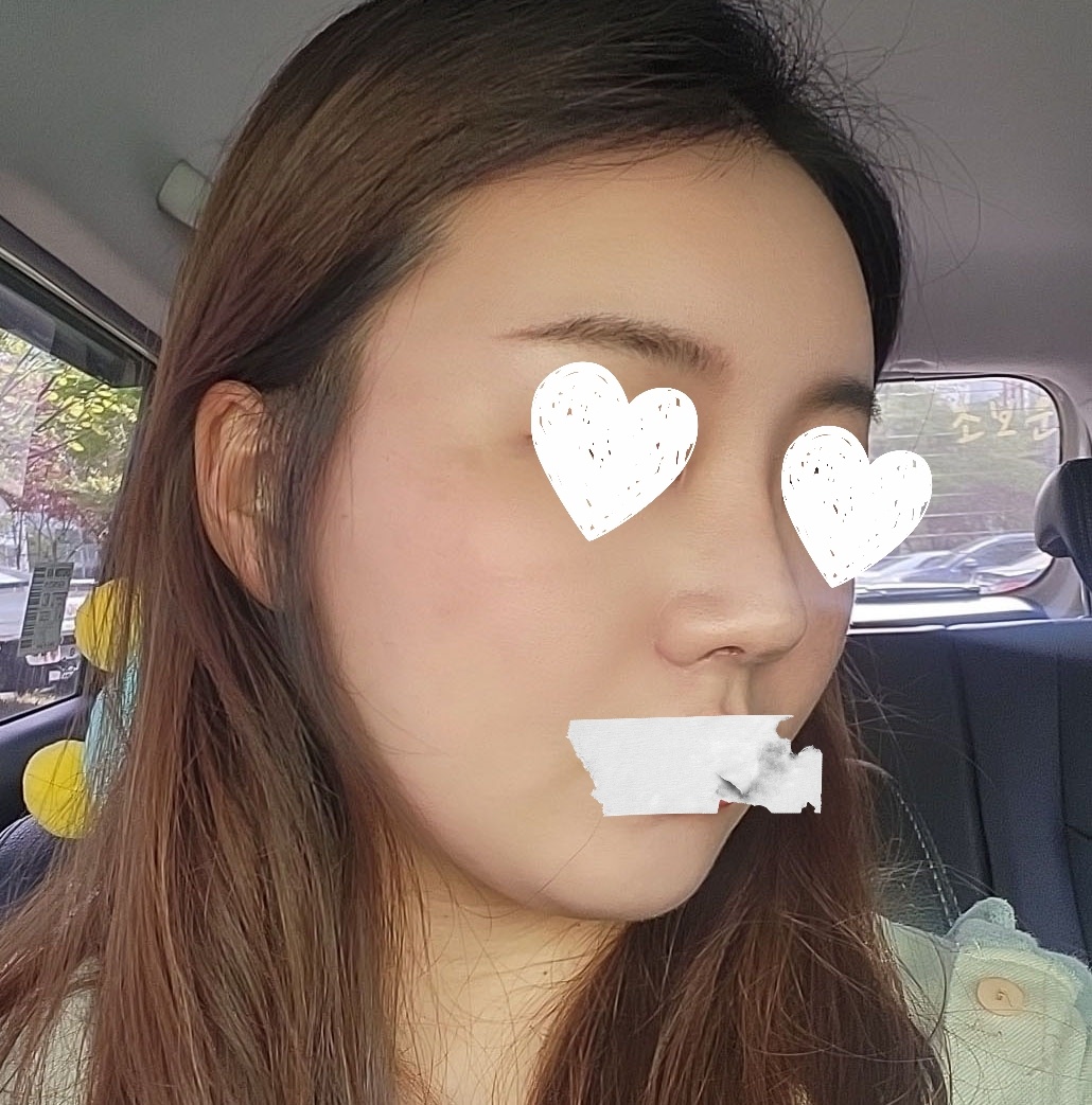 눈재수술, 코, 지방이식 3개월차~~