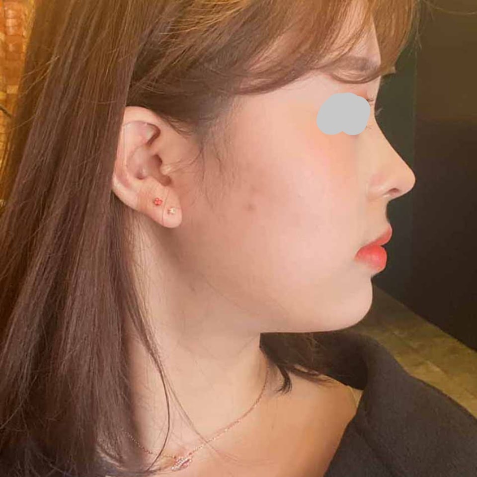 얼굴라인, 코라인이 엄청 높아지고 달라졌어요