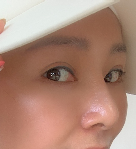 수술하고 벌써 한달이나 됐다니!