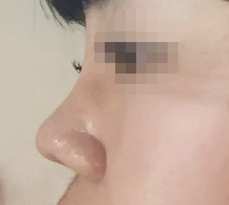 낮고 뭉툭했던 코, 오똑해진 후기ㅎ.ㅎ