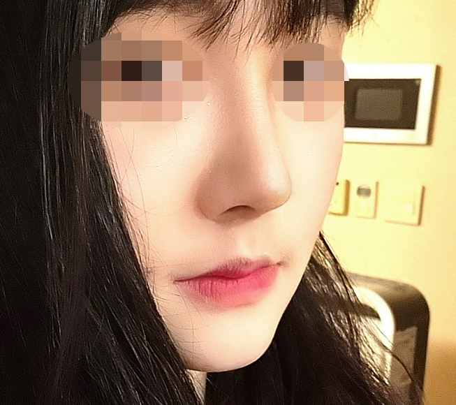 바이브에서 수술받고 넘나 만족:)