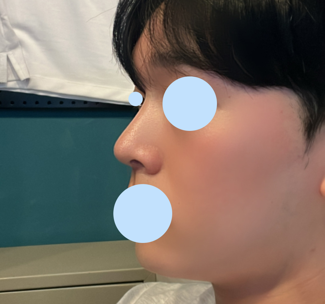 남자 매부리코성형 찐만족!!!굿!!