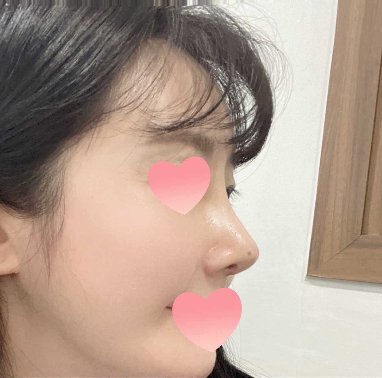 내돈내산 코수술후기!!