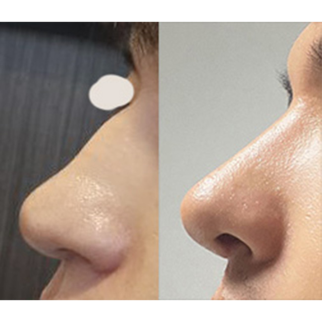 심한 매부리코 잘 다듬어진 후기