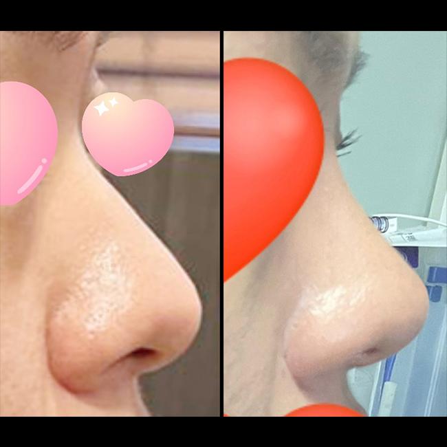 콧볼축소+복코수술 5개월되었어요~