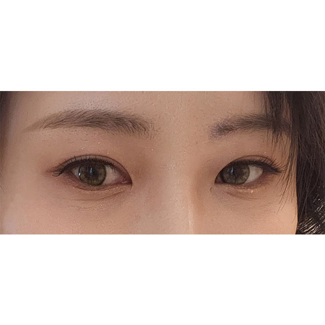 겹쌍꺼풀 눈성형 잘된 후기(6개월차!)
