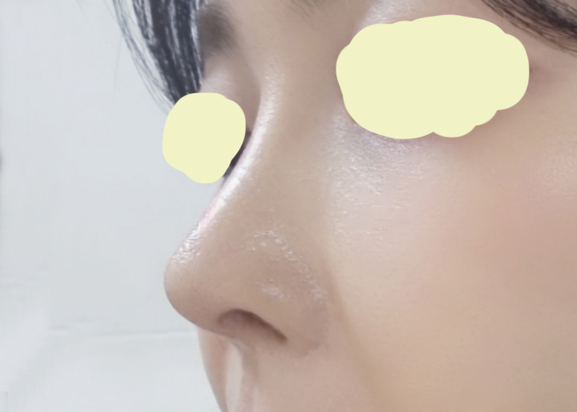 제 인생 마지막 코재수술해주셨어요~