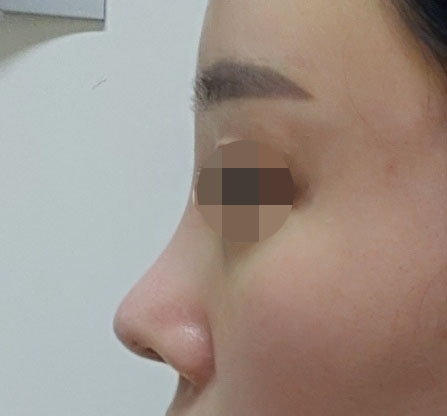 코재수술 2달넘었습니다!