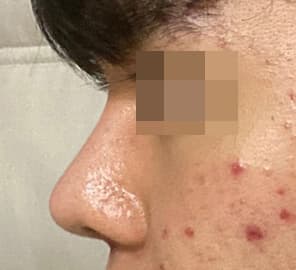 복코 + 짧은코 남자코수술 후기입니다