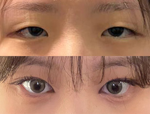 눈성형 마음에 들어요~!