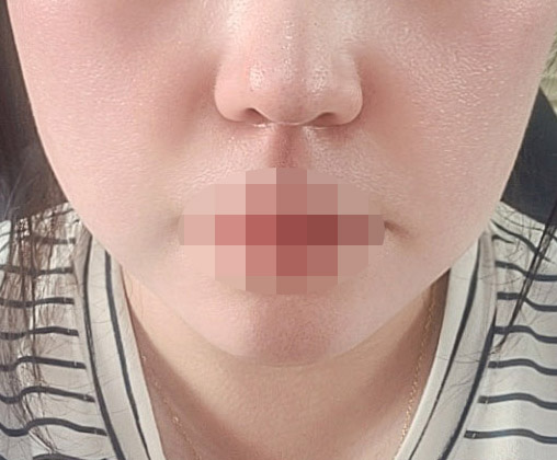 수술후_4_-턱-1.jpg