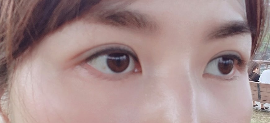 쌍꺼풀 수술 만족스럽네요