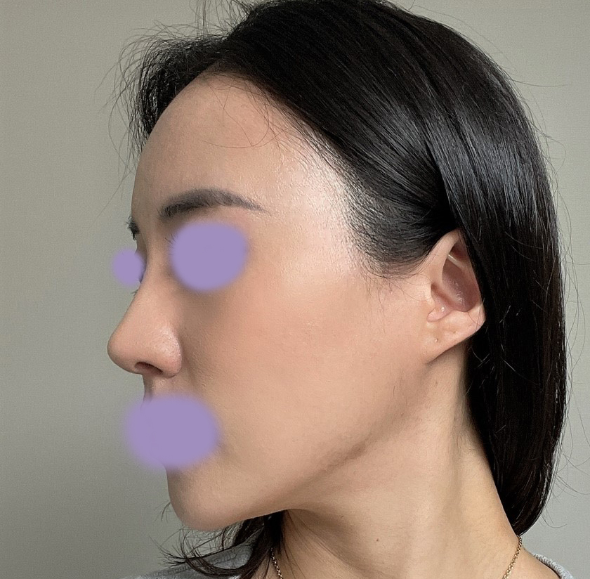 코랑 지방이식4갤차, 자연+화려해요 ㅎㅎ