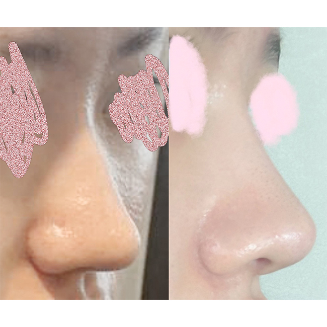 코재수술만족! 사후관리도 좋아요:)