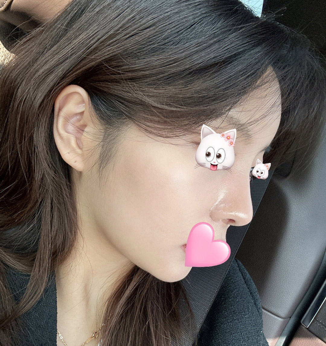 코랑 지방이식 후기가져와쏘요~