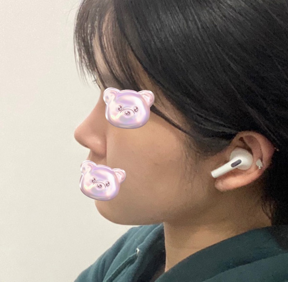 복코수술 3개월차V_V