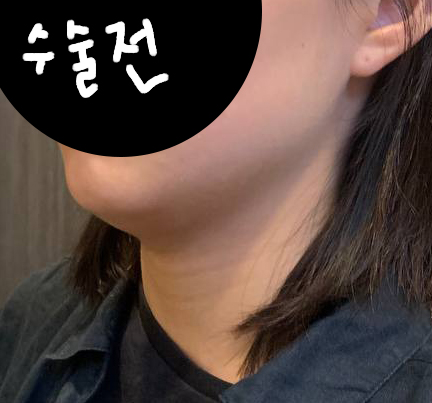 수술전_1_.jpg