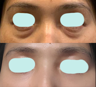 눈밑지방재배치 유영문원장님께 받았어요