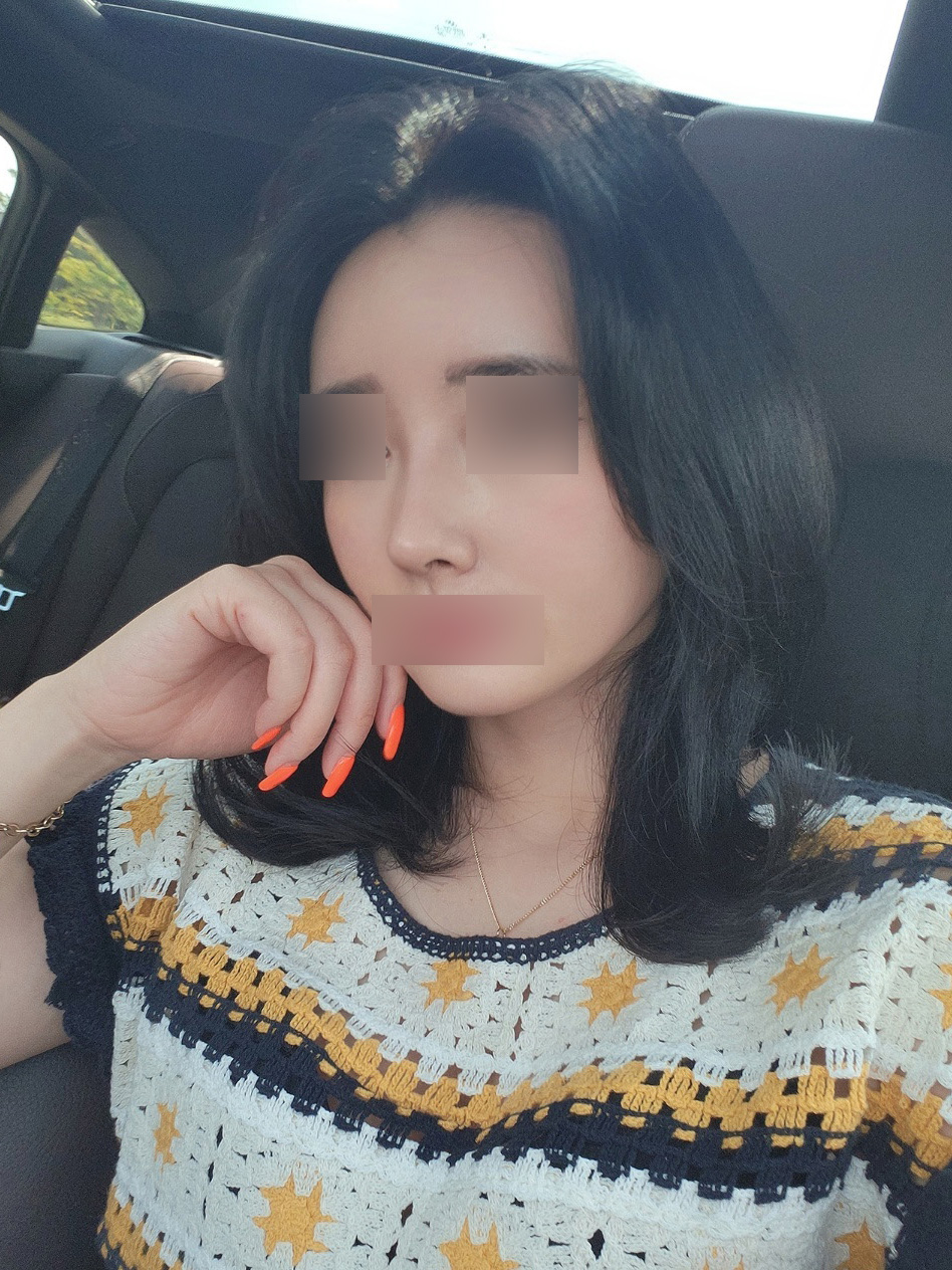 무보형물 코, 이마+관자 지방이식