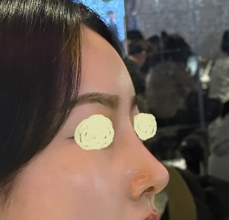 바이브성형외과에서 코랑 얼굴지방이식했습니다:)