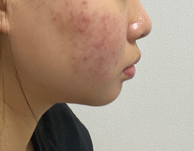 이중턱지방흡입 효과굿!