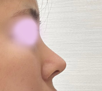 코재수술후기ㅎㅎ