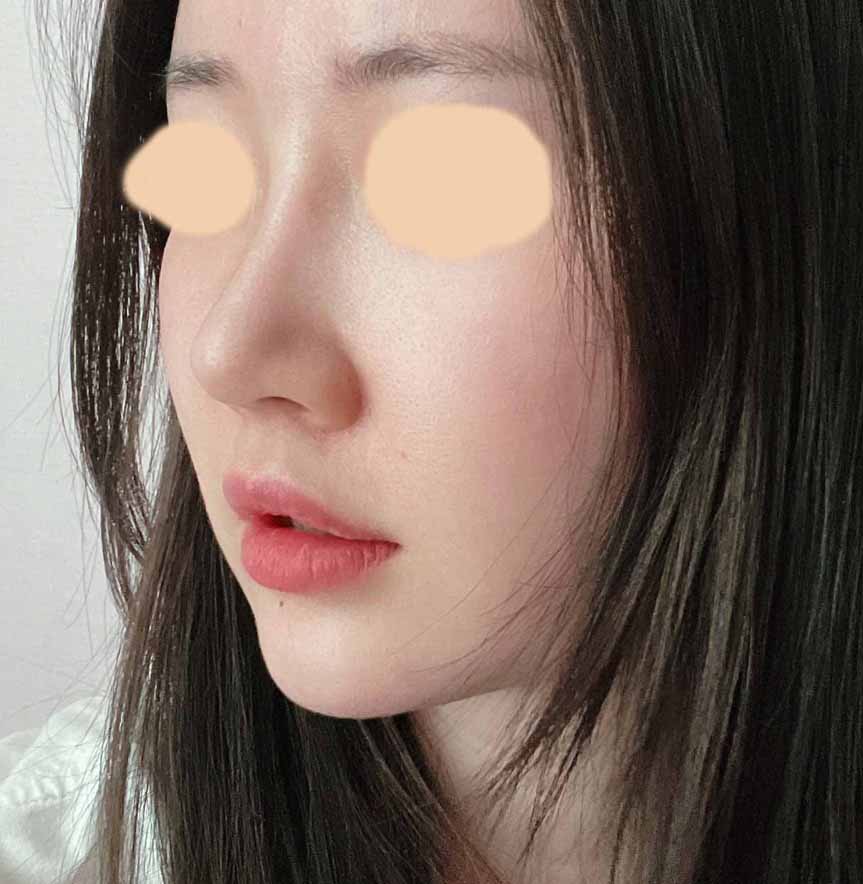 눈,코 점점 자연스러져요~~!!(+얼굴지방흡입후기)