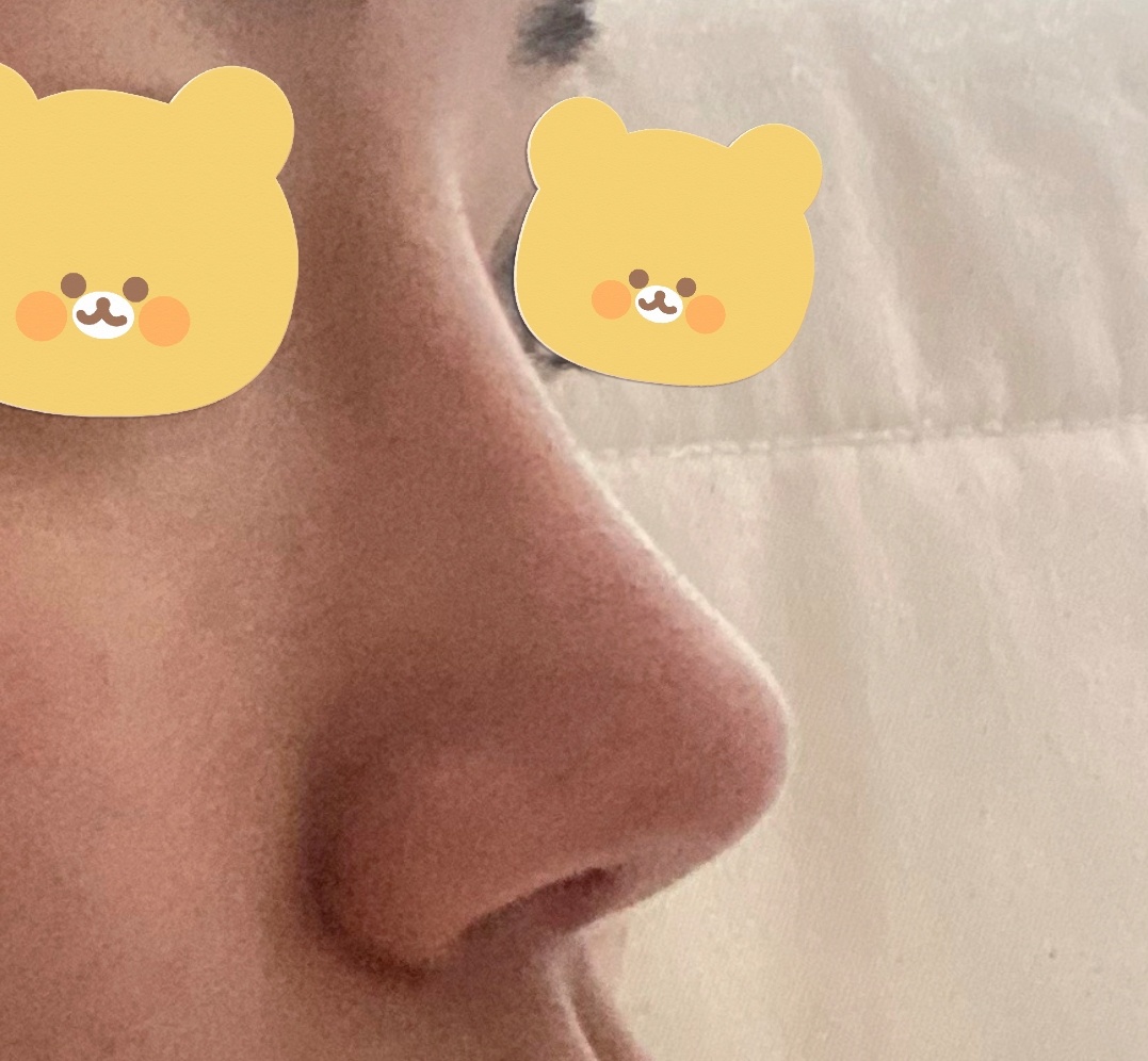 복코, 매부리코개선원한다면 바이브  추천요!