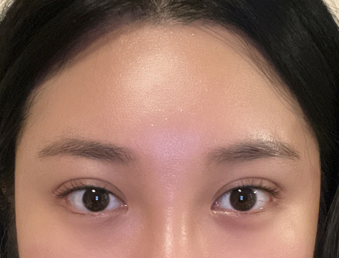 내시경이마거상,눈매교정,이중턱지방흡입