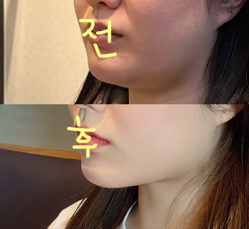 이중턱살 바이바이했습니닷!!