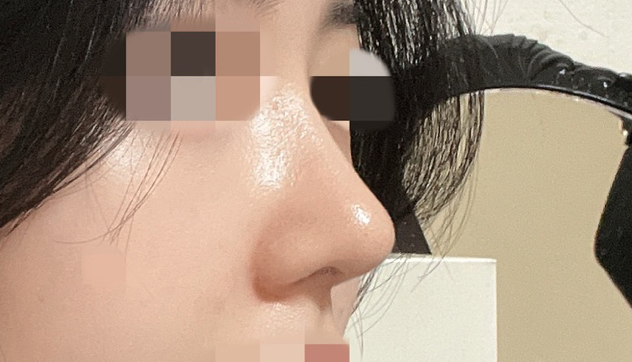 복코교정한지 4개월지났어요~