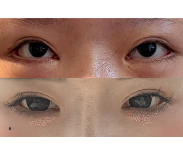 3._수술전후_정면_-눈.jpg