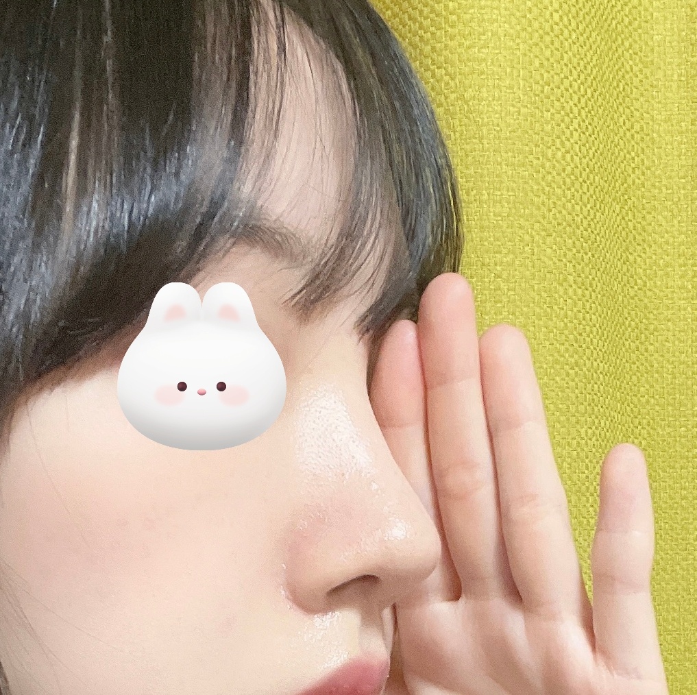 무보형물코수술 4개월차입니당